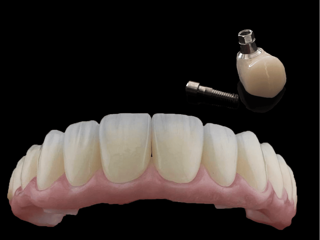 implant solution (4)