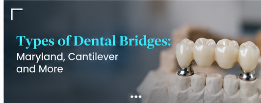 types of dental bridges